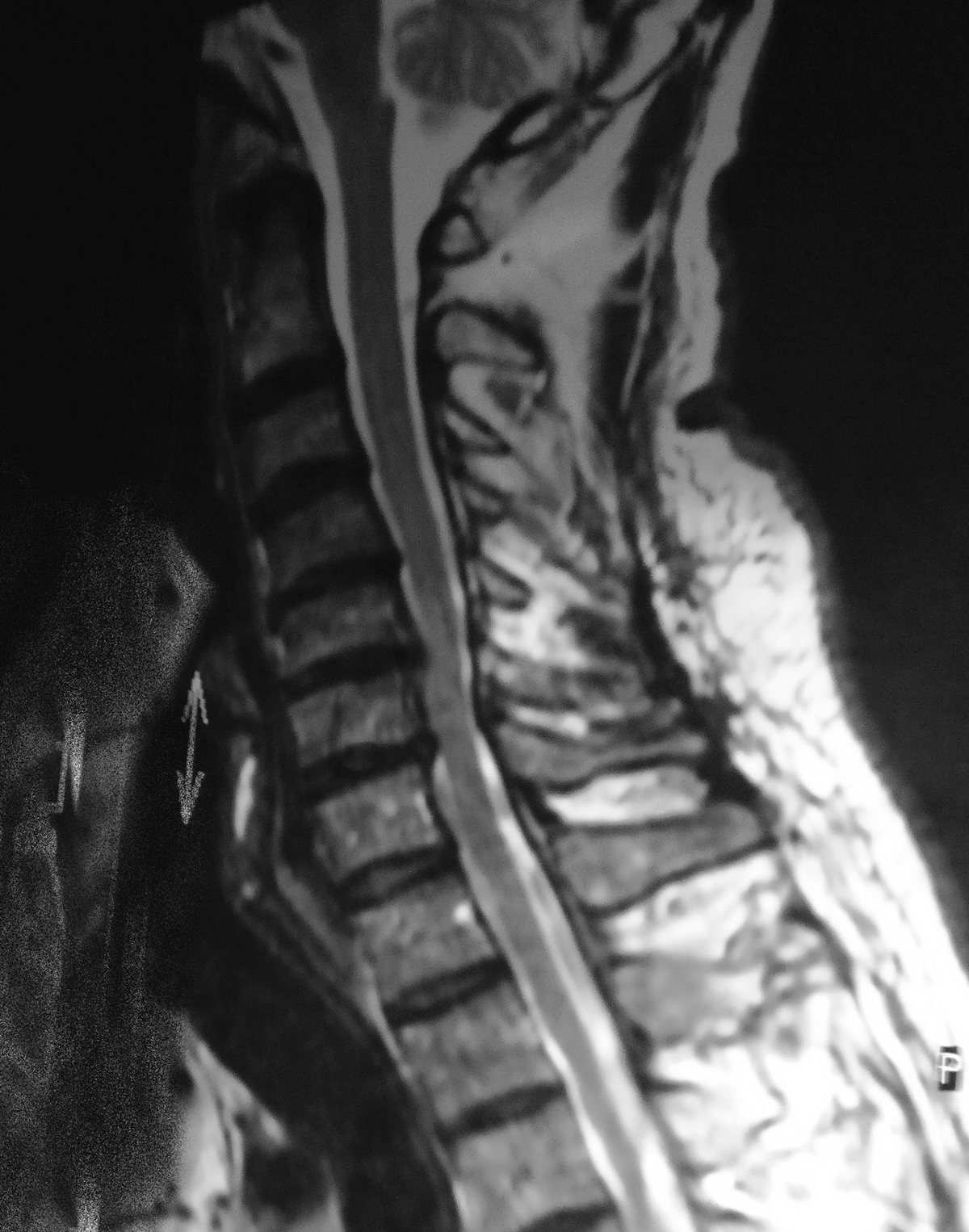 Cervical Stenosis Symptoms General Center Steadyhealth 25056 Hot Sex