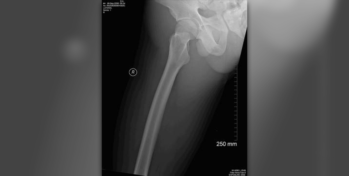 Femur Bone Fracture Surgery