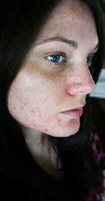 thumb_acne.jpg