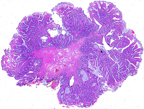 hemorrhoids reasons