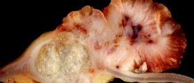 Colorectal Surgery: What To Expect From Your Bowel Cancer Operation
