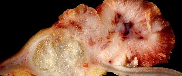 Forum on this topic: Colon Cancer: What Do the Stages Mean, colon-cancer-what-do-the-stages-mean/ Communication on this topic: Colon Cancer: What Do the Stages Mean, colon-cancer-what-do-the-stages-mean/