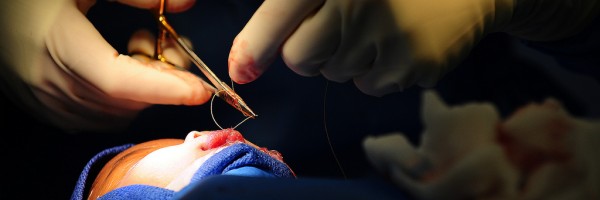 Cleft Lip And Cleft Palate: What To Expect