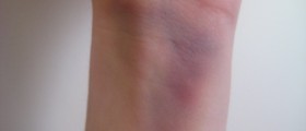 Living With Gaucher’s Disease