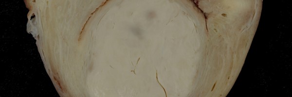 Uterine fibroids during pregnancy