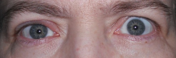 How To Treat A Stye At Home