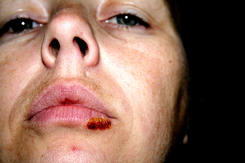 Cold Sores Herpes Simplex Virus Causes Prevention Symptoms And Treatment Skin And Hair
