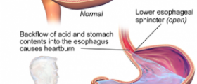 Acid reflux treatment secrets