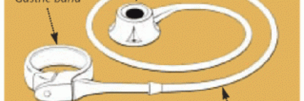 How much could i expect to pay for lap band surgery?