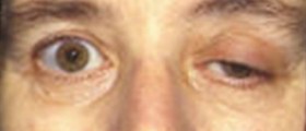 Prevention of myasthenia gravis