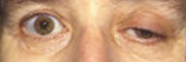 Prevention of myasthenia gravis
