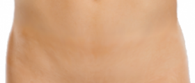 What is pelvic organ prolapse?