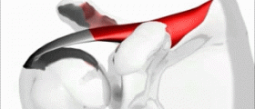 Chronic rotator cuff tear