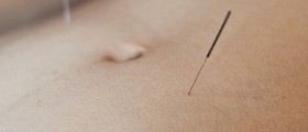 Unexplained Infertility and Acupuncture