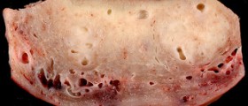 What is adenomyosis?