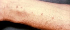 Rash on hands and neck