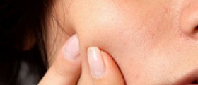 How to Treat PCOS Acne