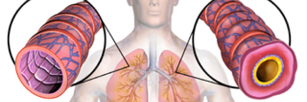 Cough variant asthma