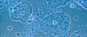What is bacterial vaginosis?
