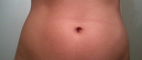 Development of stretch marks