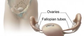 Does NovaSure prevent pregnancy, or just lighten periods?