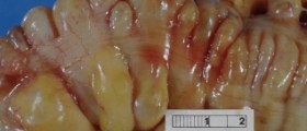 Diverticulitis surgery recovery