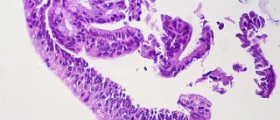 Endometrial biopsy procedure