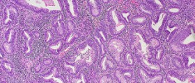 What is endometrial hyperplasia?