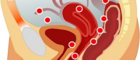 What are the symptoms of endometriosis?