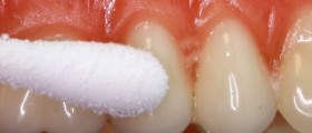 Bleeding gums during pregnancy