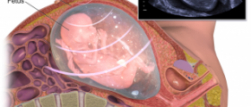 Fetal distress - what now?