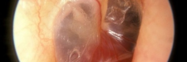 Benign neck tumor