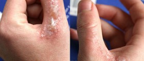 Rash on hands and ankles