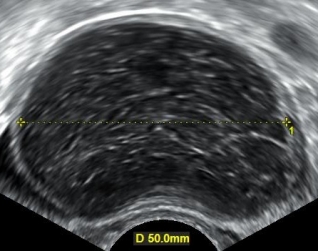 ovarian hemorrhagic symptoms cysts cyst treatment steadyhealth bleeding