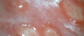 Recurrent genital herpes in pregnancy