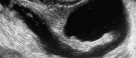 Fluid in the fallopian tubes