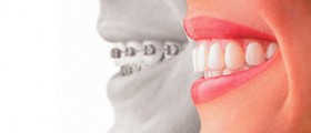 How much do invisible braces cost?