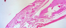 What causes ovarian cyst rupture?