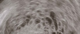 What is a molar pregnancy?