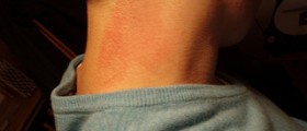 Rash on back of neck