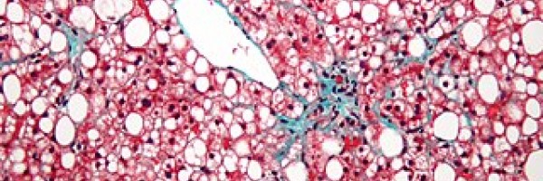 What is a fatty liver