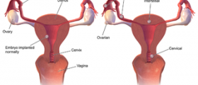 Chances of getting pregnant after ectopic pregnancy