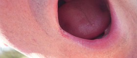 Mouth sores treatment