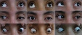 Chronic progressive external ophthalmoplegia