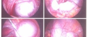 What are the symptoms of an ovarian cyst?
