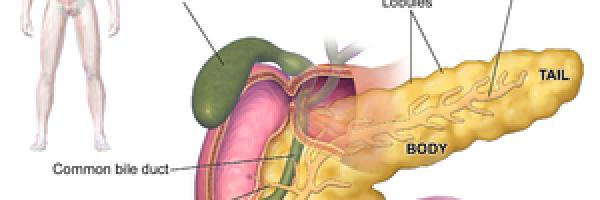 What is chronic pancreatitis