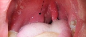About peritonsillar abscess