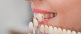Porcelain veneers pros and cons