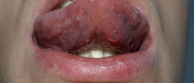 Cysts under tongue