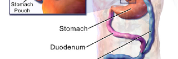 Gastric bypass surgery cost